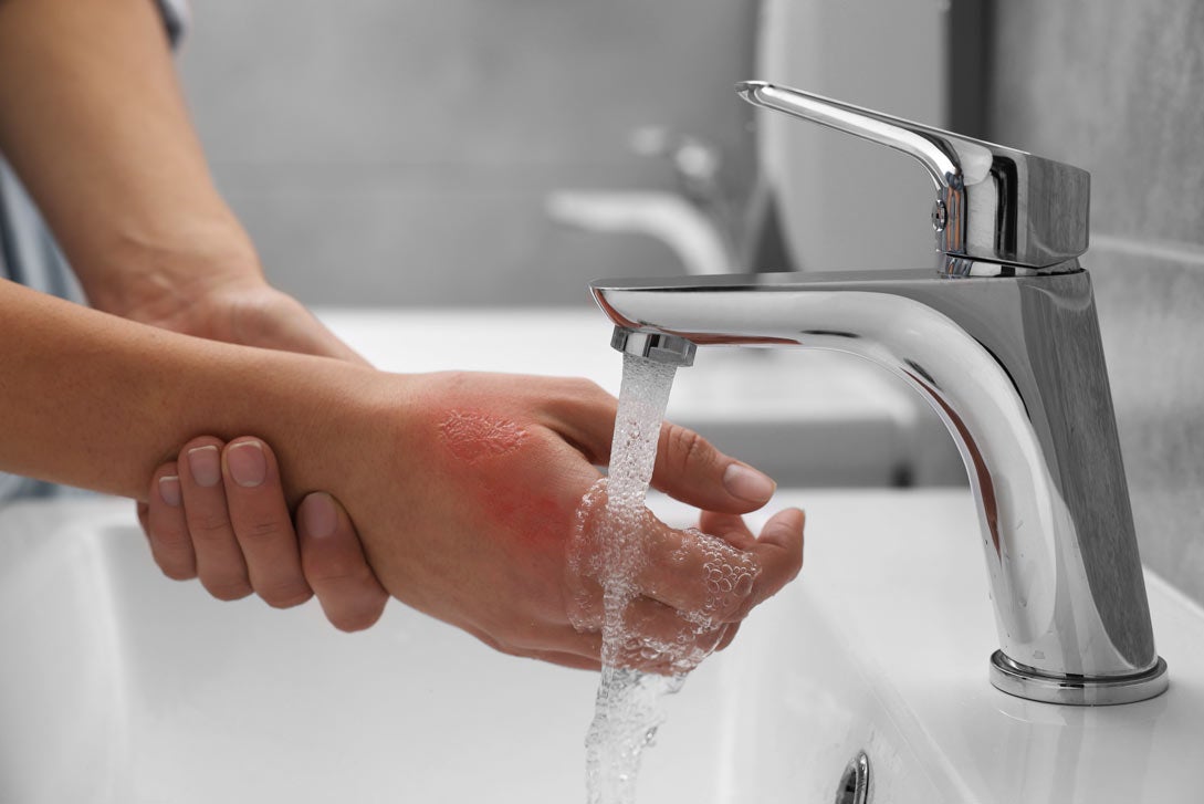 Woman holding burned hand under cold water indoors